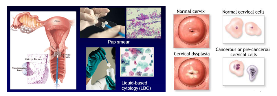 Cervical Cancer - Dr. Deepali Prabhat