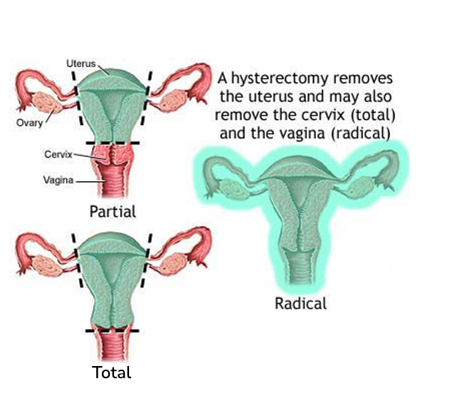 Hysterectomy Cervical Cancer