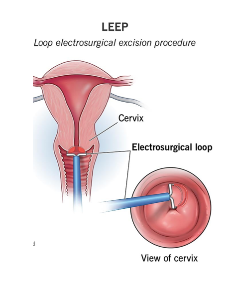 LEEP - Cervical Cancer - Dr. Deepali Prabhat